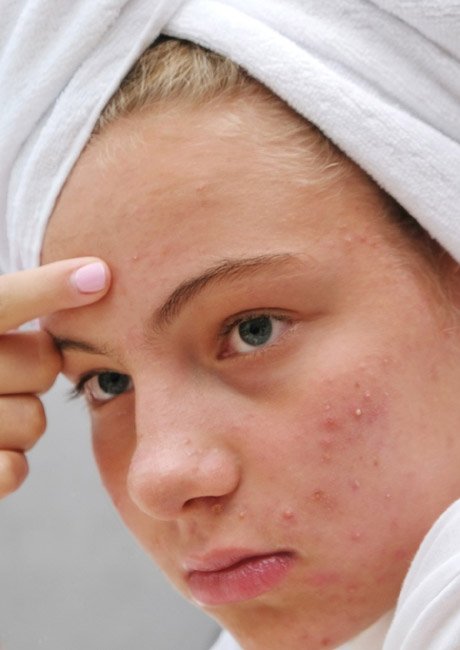 Acne & Acne Scar Treatment